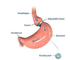 Laparoscopic Gastric Banding