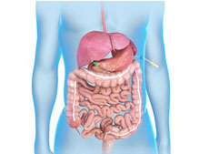 Laparoscopic Sleeve Gastrectomy